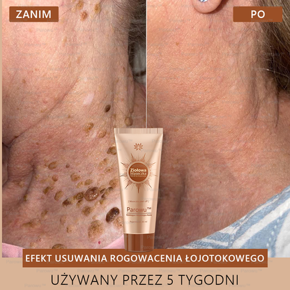 Parowu™ Wybielająca i Rozjaśniająca Maska - Naturalne składniki trwale usuwają plamy, piegi i przebarwienia🔥🔥🔥🔥